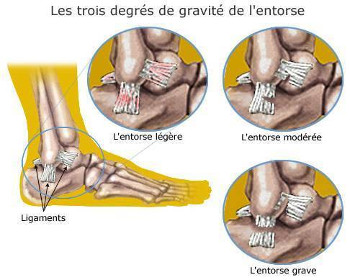 ostéopathie et entorse